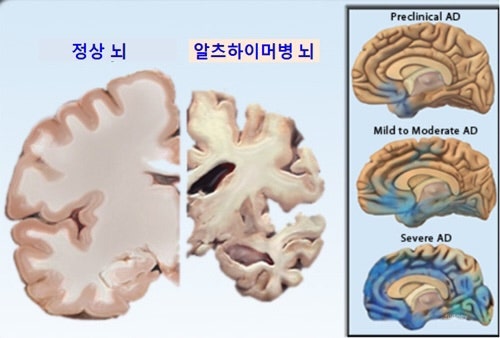 정상 뇌와 알츠하이머 환자의 뇌 비교